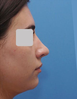 Rhinoplasty Before & After Gallery - Patient 255064 - Image 2