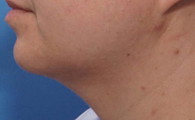 Chin Surgery Before & After Gallery - Patient 875047 - Image 2