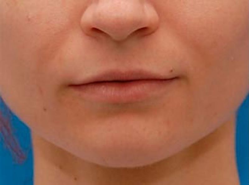 Lip Fillers Before & After Gallery - Patient 243422 - Image 1