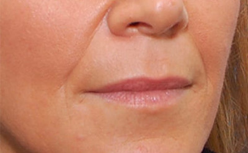Fillers Before & After Gallery - Patient 361301 - Image 3