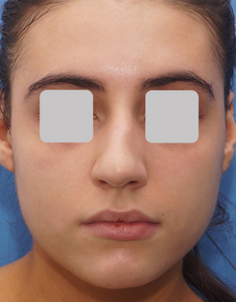 Rhinoplasty Before & After Gallery - Patient 564738 - Image 3