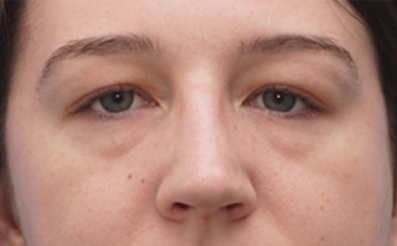 Patient KoDQ1V96TTqIgGj6OkkfNw - Eyelid Surgery Before & After Photos