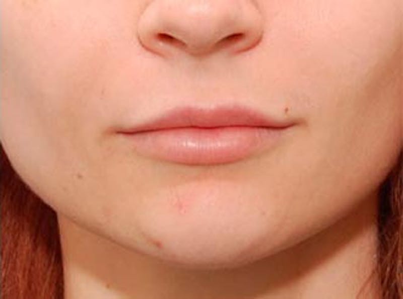Lip Fillers Before & After Gallery - Patient 243422 - Image 2