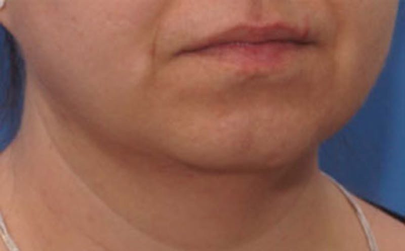 Chin Surgery Before & After Gallery - Patient 875047 - Image 3