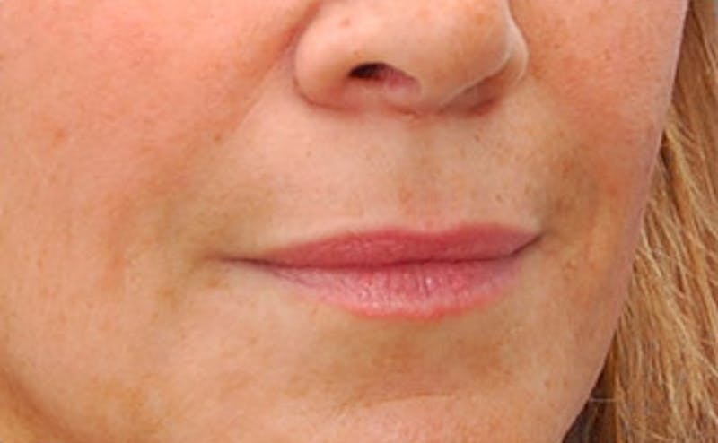 Fillers Before & After Gallery - Patient 361301 - Image 4