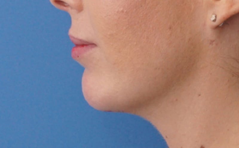FaceTite Before & After Gallery - Patient 974169 - Image 6