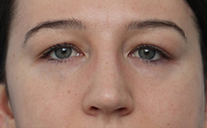 Eyelid Surgery Before & After Gallery - Patient 205231 - Image 2