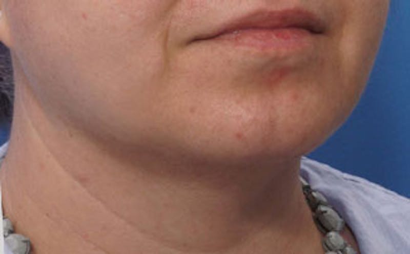 Chin Surgery Before & After Gallery - Patient 875047 - Image 4