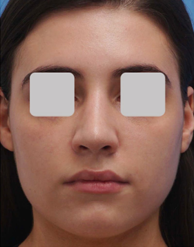 Rhinoplasty  Before & After Gallery - Patient 255064 - Image 4