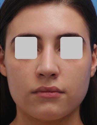 Rhinoplasty Before & After Gallery - Patient 255064 - Image 4