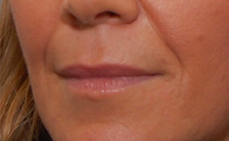 Fillers Before & After Gallery - Patient 361301 - Image 5