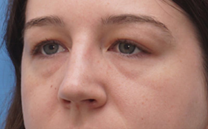 Eyelid Surgery Before & After Gallery - Patient 205231 - Image 3
