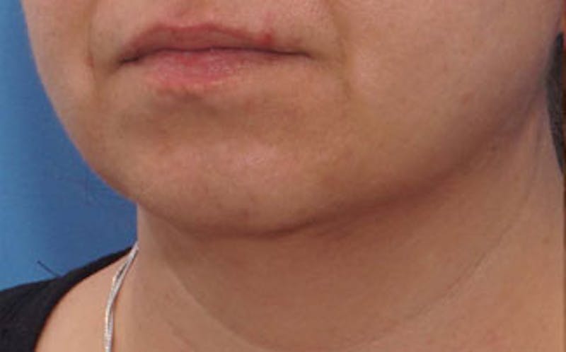 Chin Surgery Before & After Gallery - Patient 875047 - Image 5