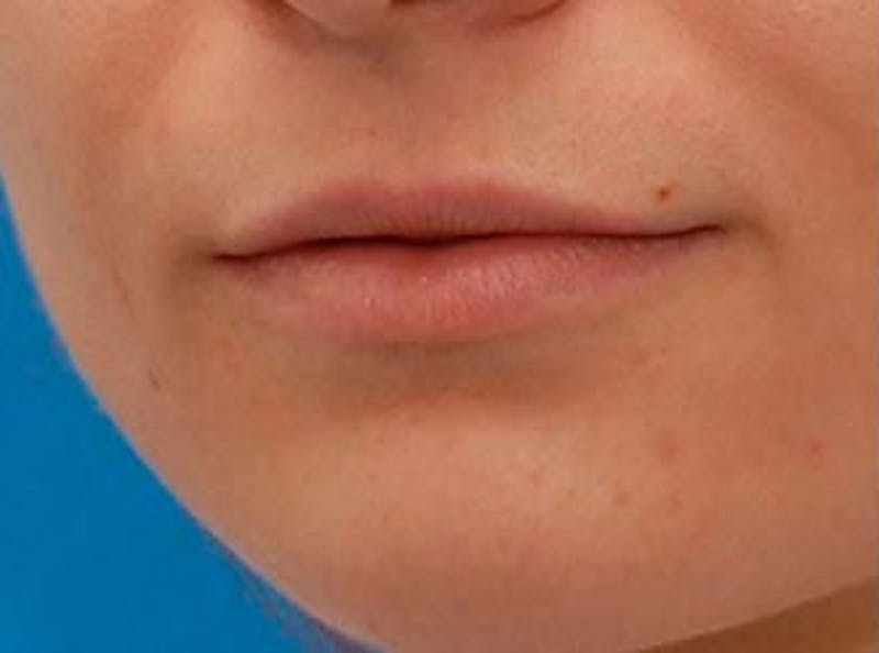 Lip Fillers Before & After Gallery - Patient 243422 - Image 3