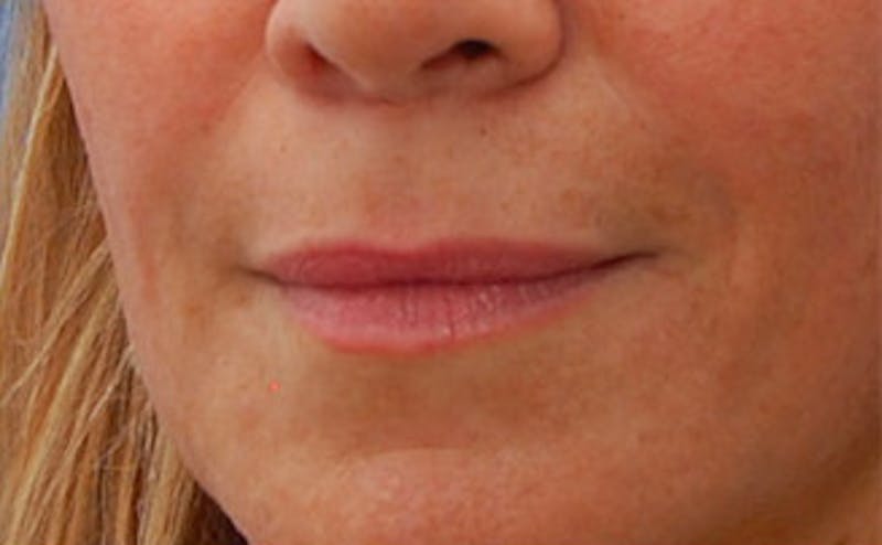 Fillers Before & After Gallery - Patient 361301 - Image 6