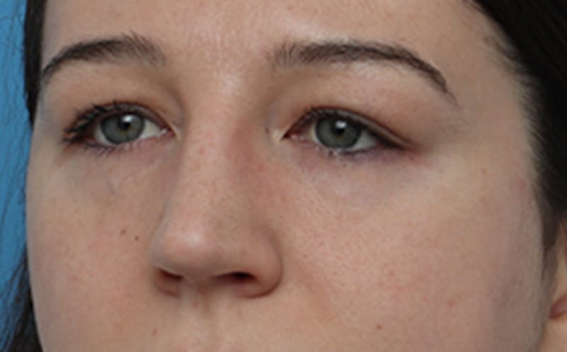 Eyelid Surgery Before & After Gallery - Patient 205231 - Image 4
