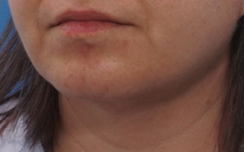 Chin Surgery Before & After Gallery - Patient 875047 - Image 6