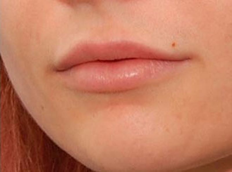 Lip Fillers Before & After Gallery - Patient 243422 - Image 4