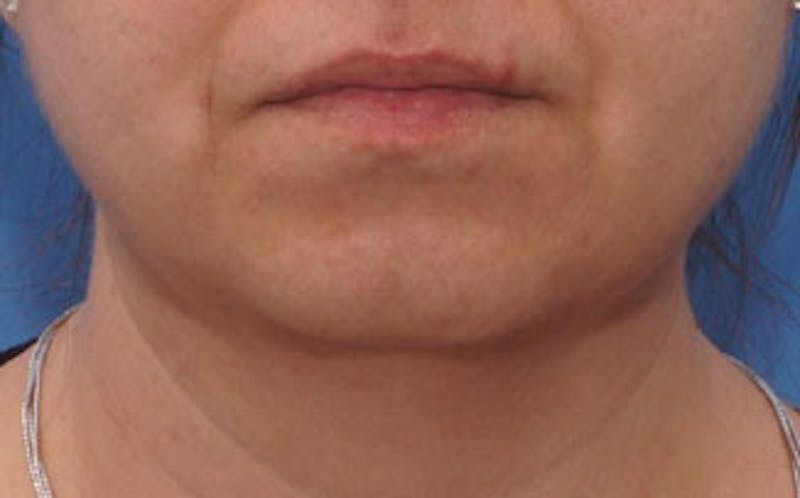 Chin Surgery Before & After Gallery - Patient 875047 - Image 7