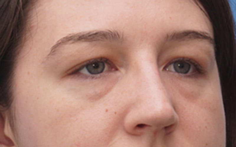 Eyelid Surgery Before & After Gallery - Patient 205231 - Image 5