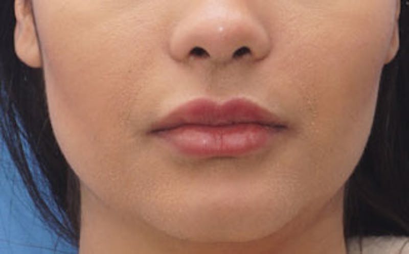 Fillers Before & After Gallery - Patient 422386 - Image 1