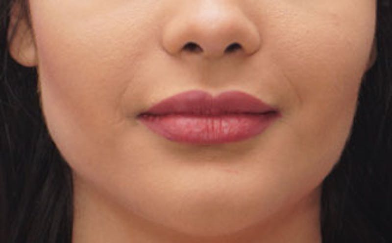 Fillers Before & After Gallery - Patient 422386 - Image 2