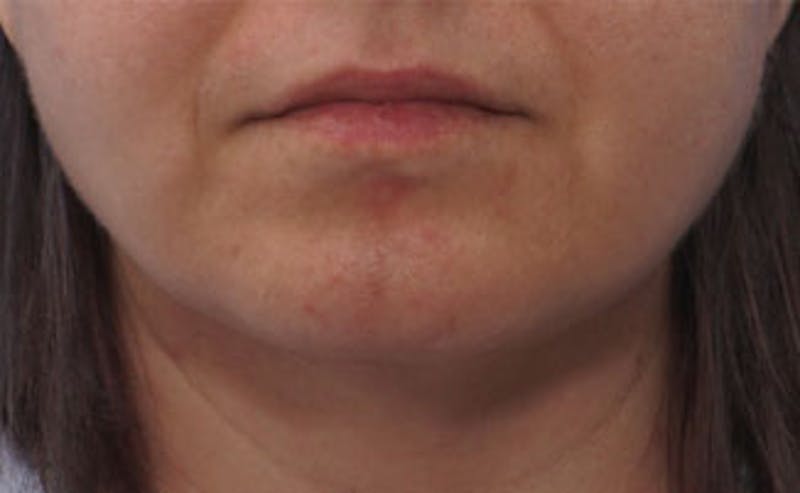 Chin Surgery Before & After Gallery - Patient 875047 - Image 8