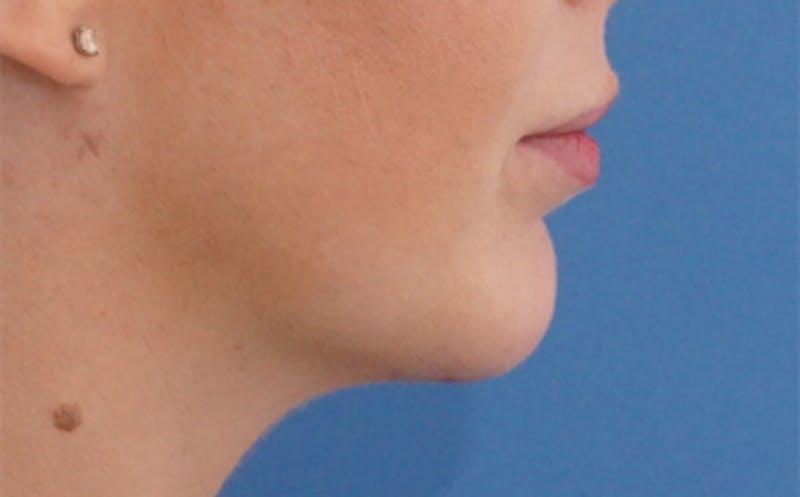 FaceTite Before & After Gallery - Patient 974169 - Image 8