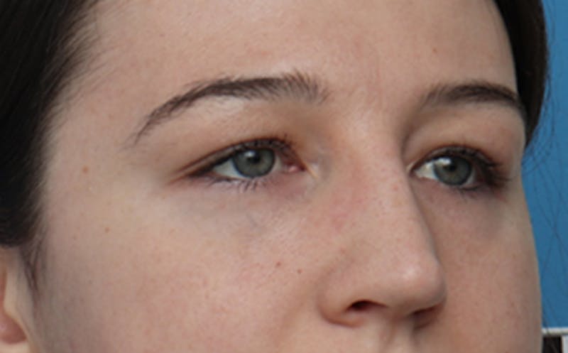 Eyelid Surgery Before & After Gallery - Patient 205231 - Image 6