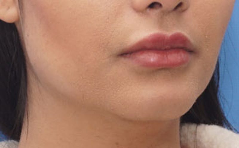 Fillers Before & After Gallery - Patient 422386 - Image 3