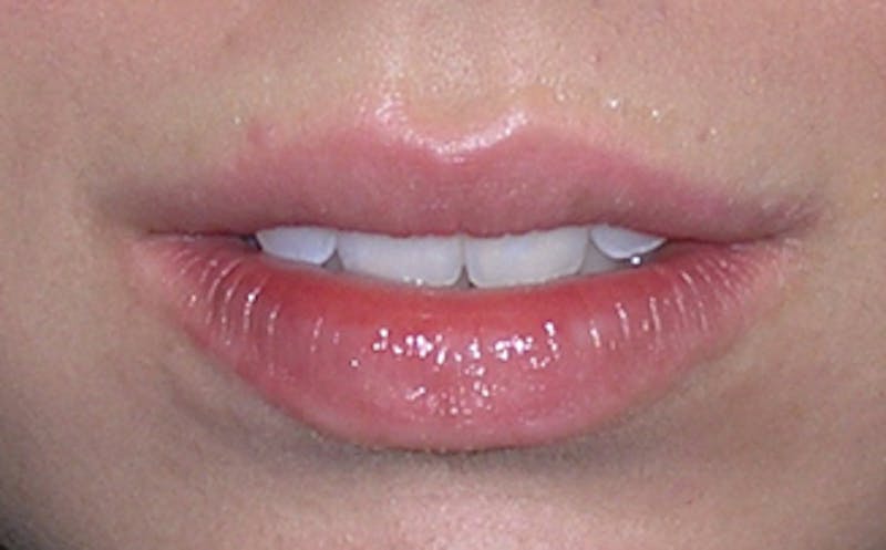 Lip Fillers Before & After Gallery - Patient 105035 - Image 1