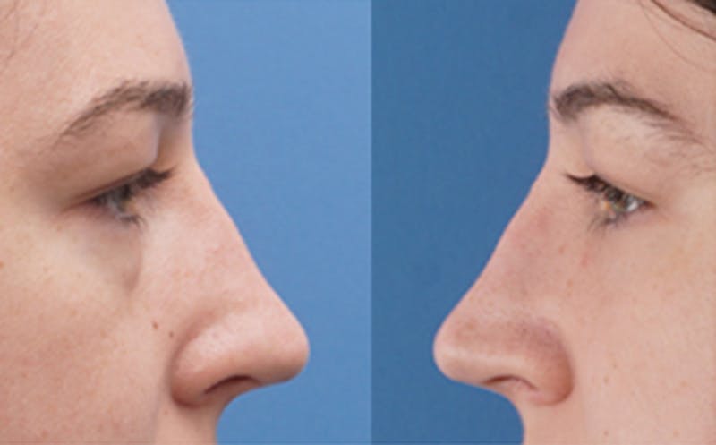 Eyelid Surgery Before & After Gallery - Patient 205231 - Image 7