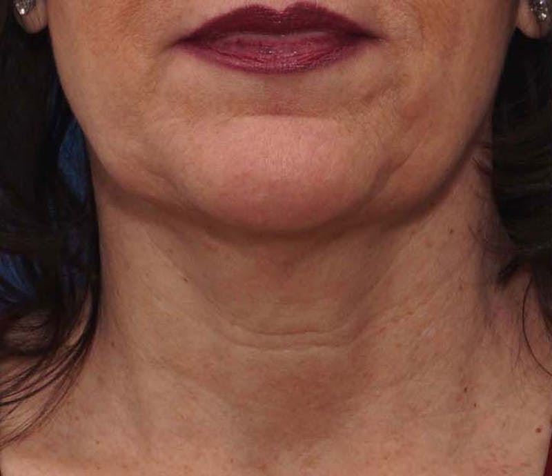 FaceTite Before & After Gallery - Patient 256615 - Image 1