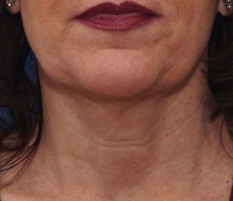 Patient Vi8Ng9QcRWKjUSKZUO2Rag - FaceTite Before & After Photos