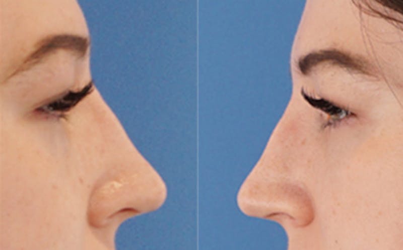 Eyelid Surgery Before & After Gallery - Patient 205231 - Image 8
