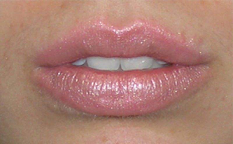 Lip Fillers Before & After Gallery - Patient 105035 - Image 2