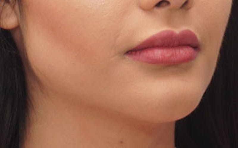 Fillers Before & After Gallery - Patient 422386 - Image 4