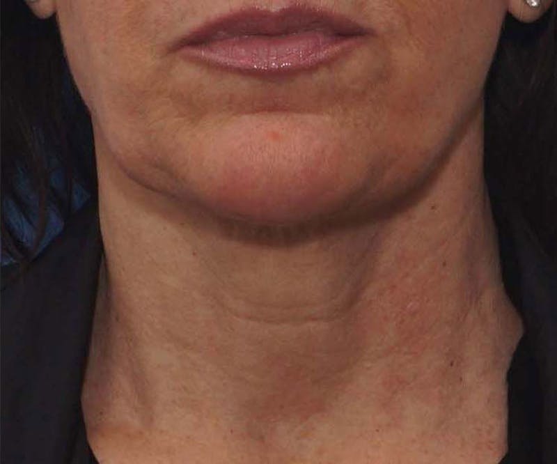 FaceTite Before & After Gallery - Patient 256615 - Image 2