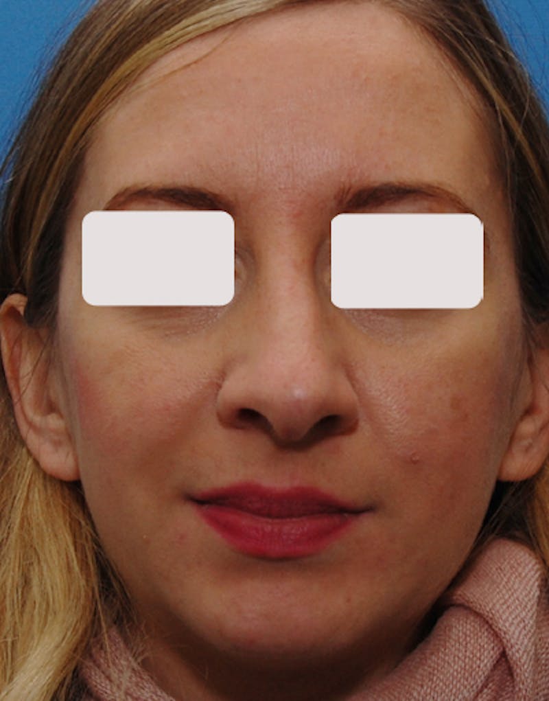 Rhinoplasty Before & After Gallery - Patient 229208 - Image 3