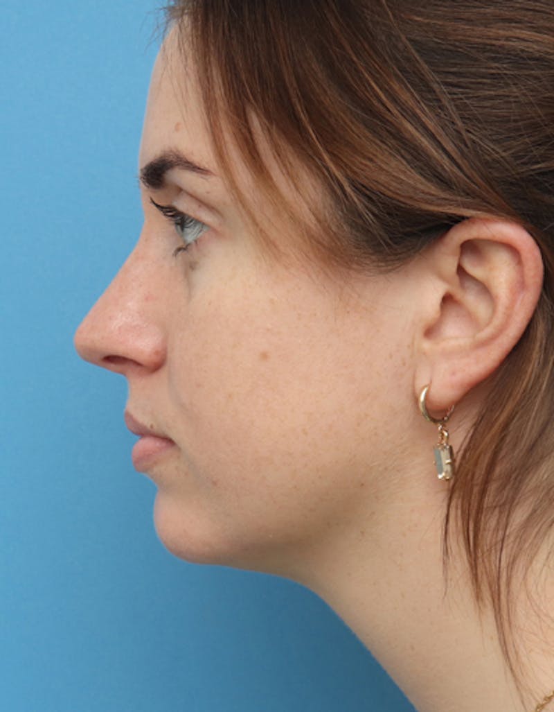 Chin Surgery Before & After Gallery - Patient 267820 - Image 1