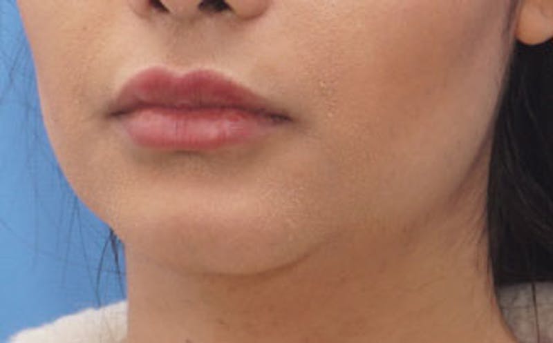Fillers Before & After Gallery - Patient 422386 - Image 5