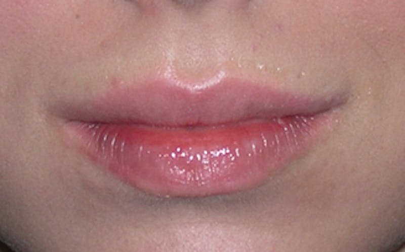 Lip Fillers Before & After Gallery - Patient 105035 - Image 3
