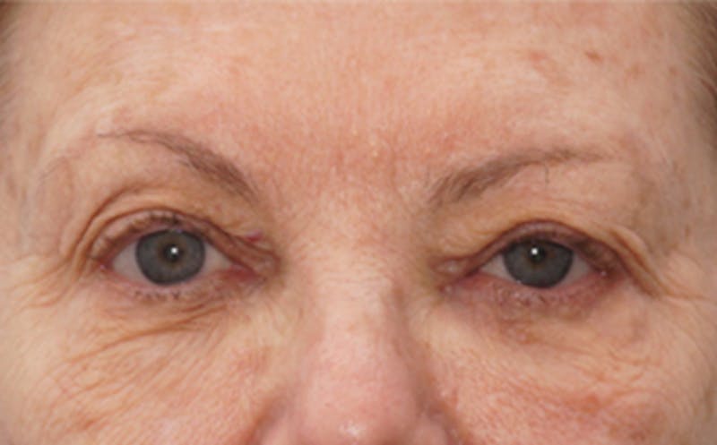 Patient MzLDHQlWRwKYA6FIHHLGEQ - Eyelid Surgery Before & After Photos