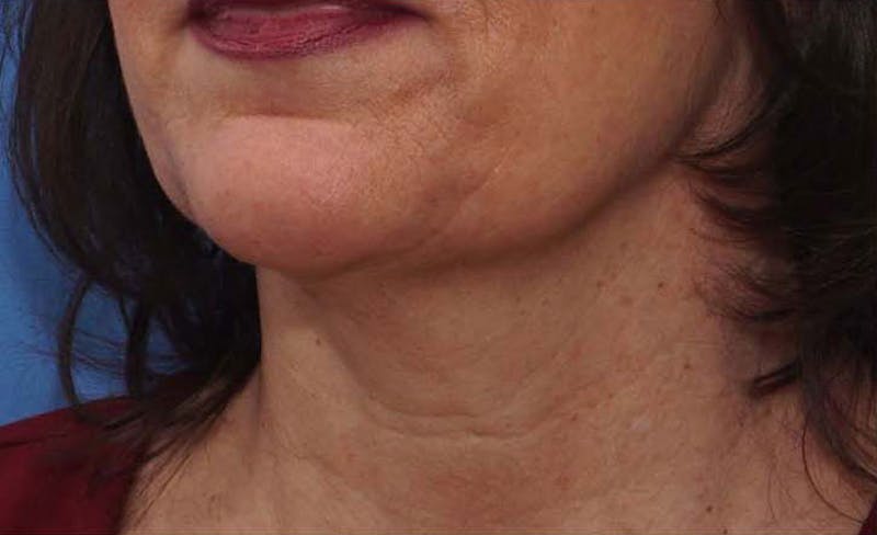 FaceTite Before & After Gallery - Patient 256615 - Image 3