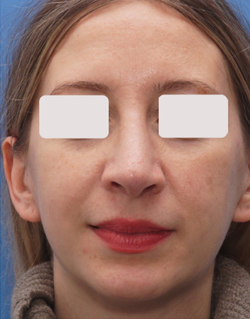 Rhinoplasty Before & After Gallery - Patient 229208 - Image 4