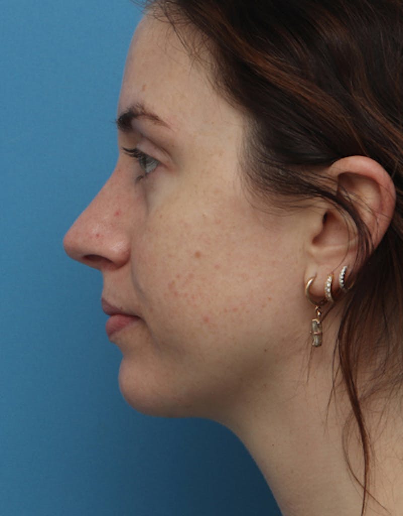 Chin Surgery Before & After Gallery - Patient 267820 - Image 2