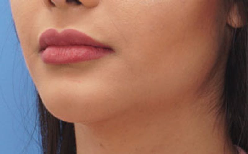 Fillers Before & After Gallery - Patient 422386 - Image 6