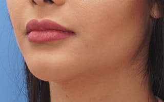 Fillers Before & After Gallery - Patient 422386 - Image 6