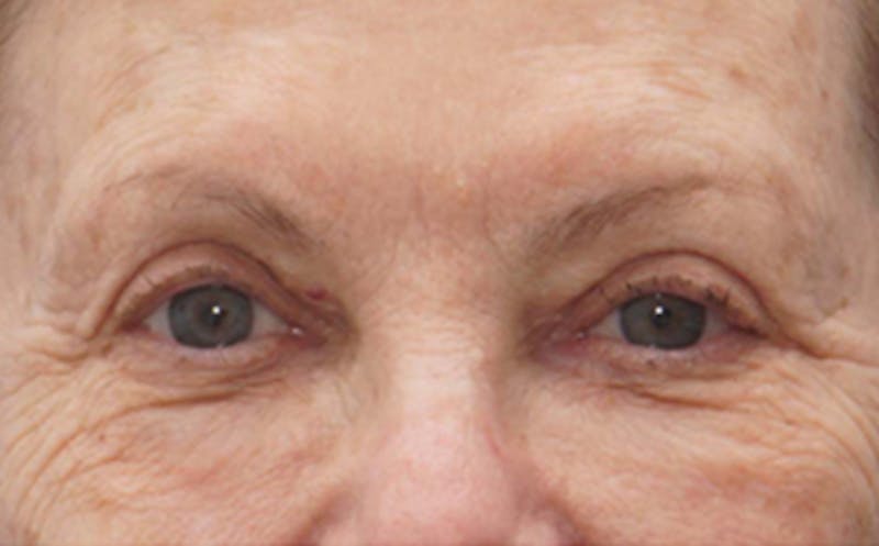 Eyelid Surgery Before & After Gallery - Patient 106125 - Image 2