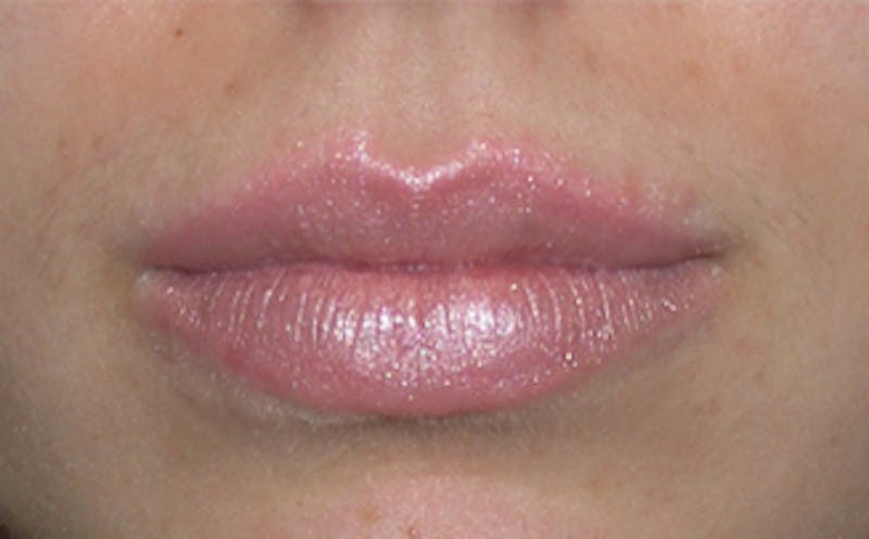 Lip Fillers Before & After Gallery - Patient 105035 - Image 4